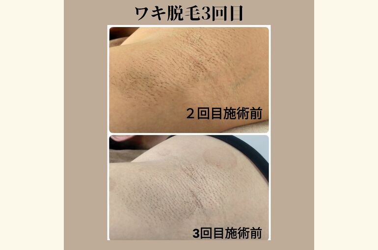 【メンズ専門脱毛サロン】匂いや蒸れの改善にも!脇脱毛がおすすめ。