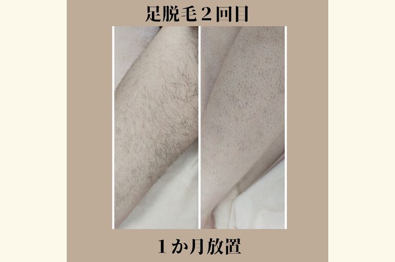 メンズ脱毛！足脱毛始めませんか？メンズも見せる足へ！