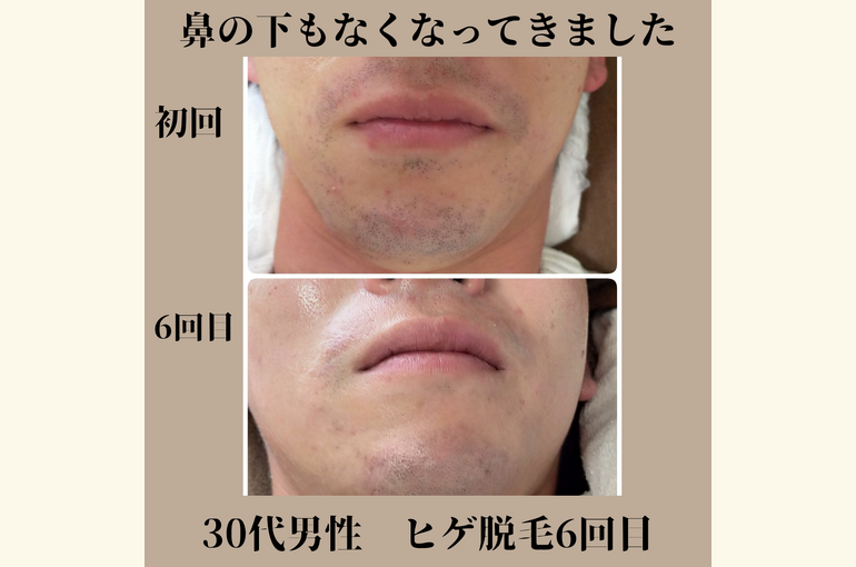 メンズ脱毛と、フェイシャルマッサージで若みえ！メンズ美容サロン